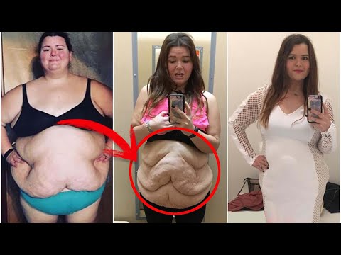 როგორი შეგრძნებაა როცა 80 კგ-ს მოიკლებ და მომჩვარული კანი \"გკიდია\".რა ხდება ამის შემდეგ?