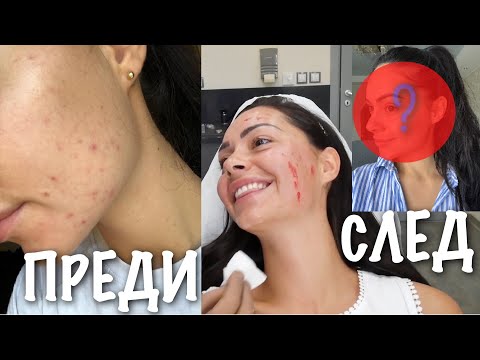 💉Вампирски лифтинг⁉️ Какво се случи с лицето ми....