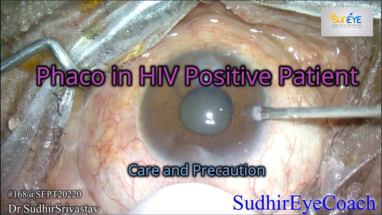 CATARACT SURGERY IN HIV POSITIVE PATEINT YouTube