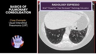 Basics Of Pulmonary Consolidation Case Example - Usual Intersial Pneumonia Uip