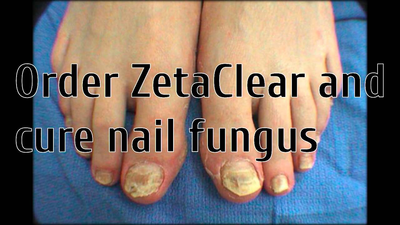 fingernail fungus laser treatment YouTube