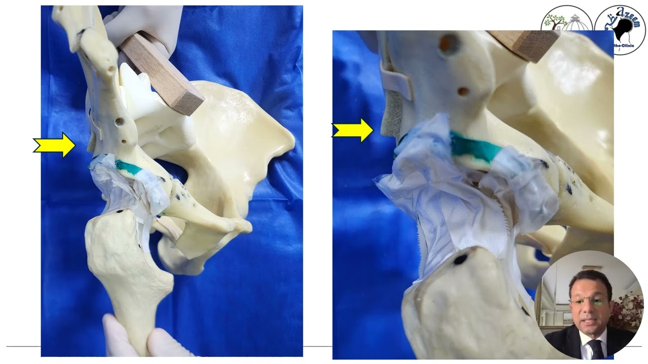 Associated Both Columns fracture  - AAAzeem 2025