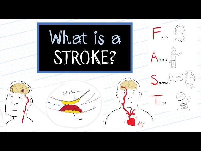 What is a Stroke? (HealthSketch) class=