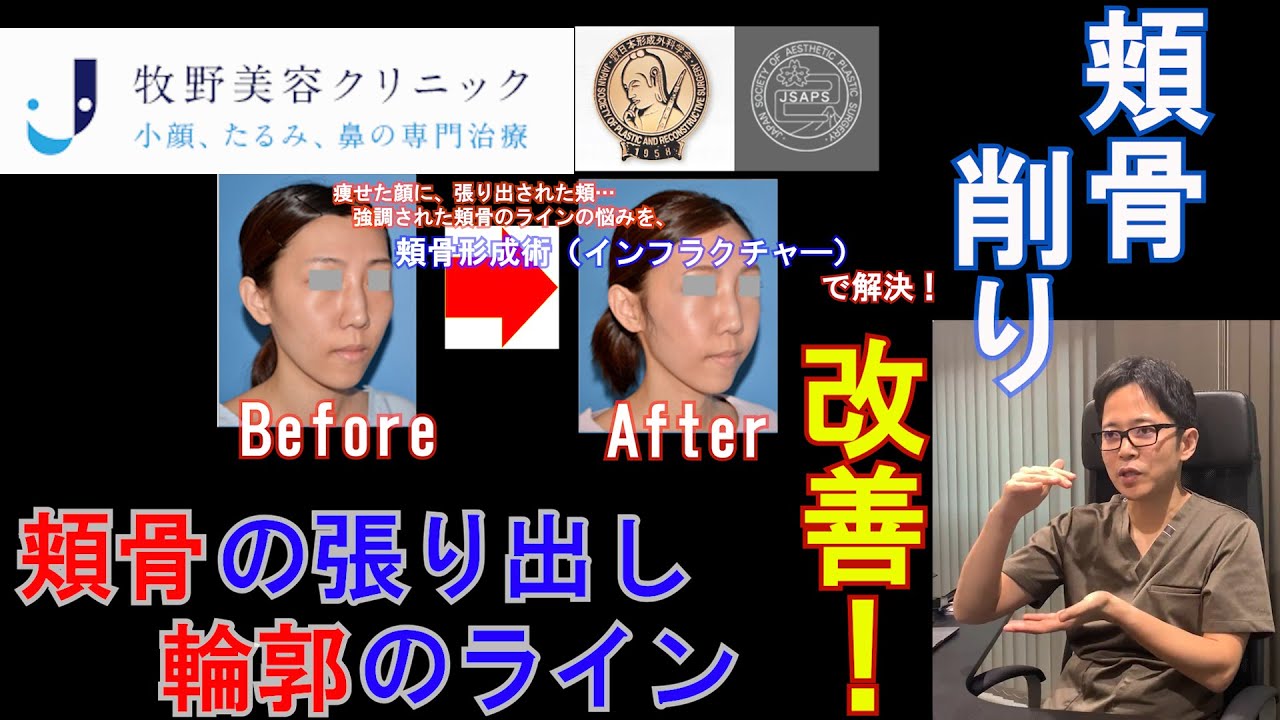 頬骨の張り出し・気になる輪郭のラインを改善！頬骨削り美容整形