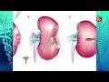 Dr Sanjai Addla, Senior Urologist / Robotic surgeon discussion management of Kidney cancer
