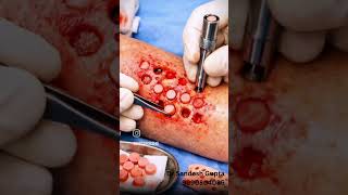 Vitiligo treatment available at affordable cost with early care playing a key role.