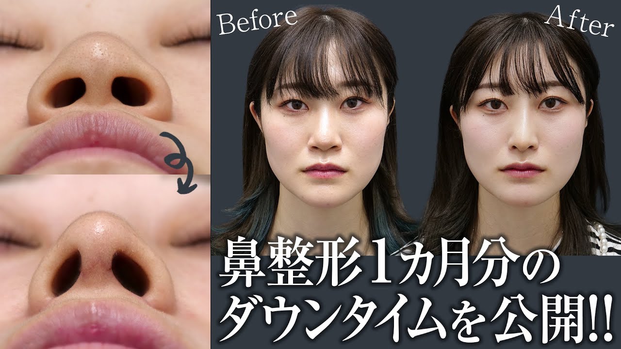 【鼻】鼻整形のダウンタイム 辛い1週間に密着!3ヶ月のビフォーアフター紹介 - YouTube