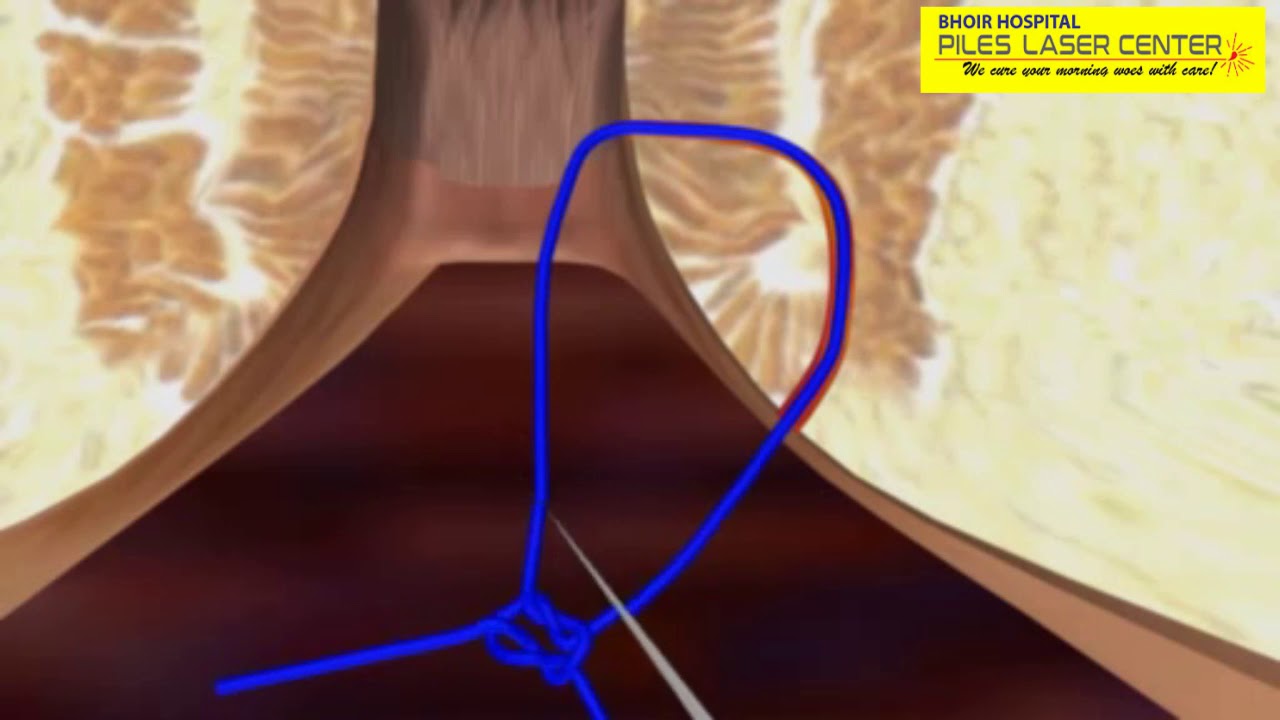 Fistula Laser Treatment YouTube Fistula Laser Treatment YouTube