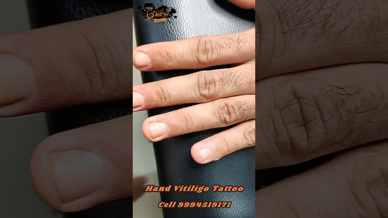 Hand Vitiligo 