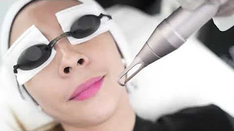 Pico Laser Melasma Treatment: Clearer Skin Awaits