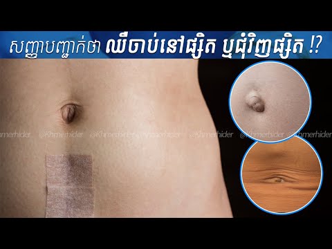 គ្រាន់តែឈឺនៅជុំវិញផ្សិត តើអ្នកគួរតែខ្វល់ ឬភ័យពីជំងឺអ្វីខ្លះទៅ | Pain Around Belly Button