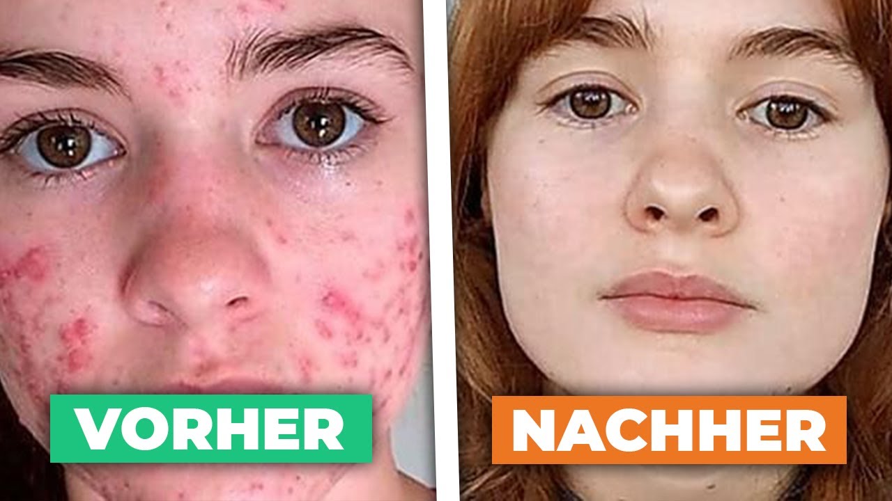 3 effektive Hausmittel gegen PICKEL