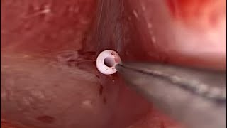 Myringotomy Surgery with Ear Ventilation Tube Grommets