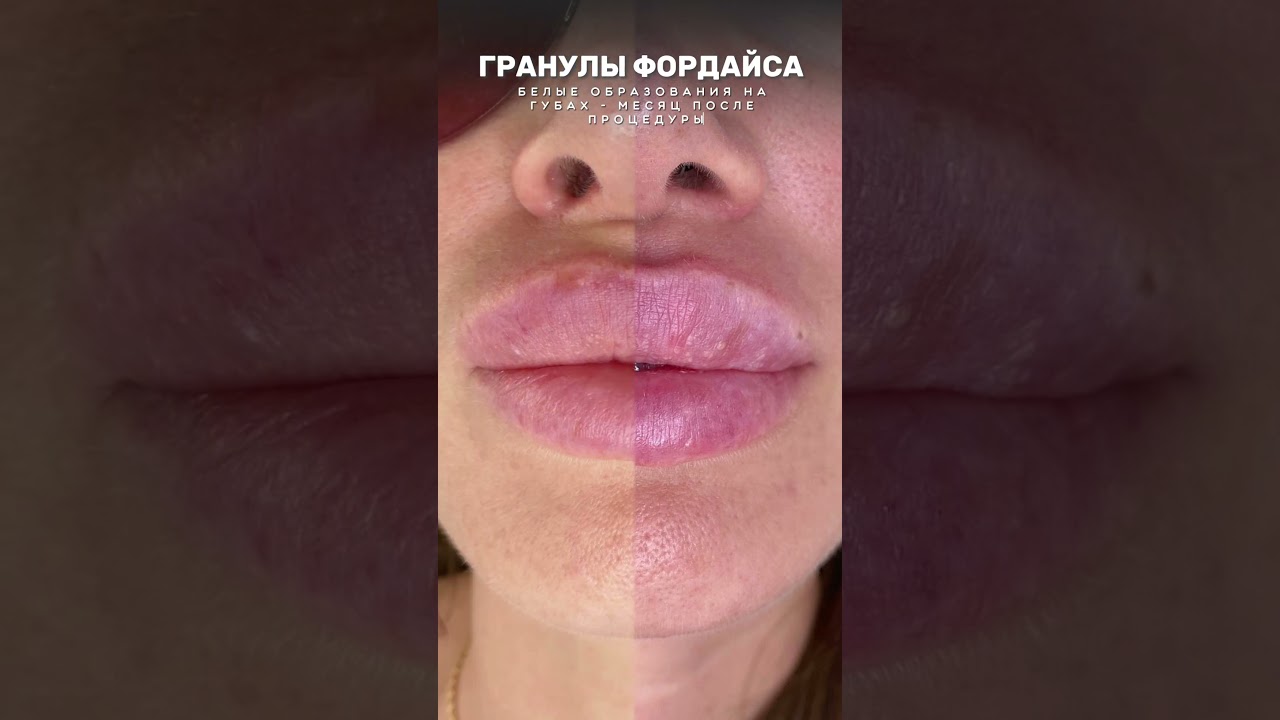 Гранулы фордайса. #гранулыфордайса #новообразование #fyp #губы #допосле #beforeafter #доипосле