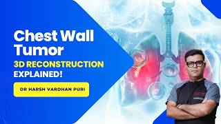 Chest Wall Tumor 3D RECONSTRUCTION EXPLAINED! DR HARSH VARDHAN PURI