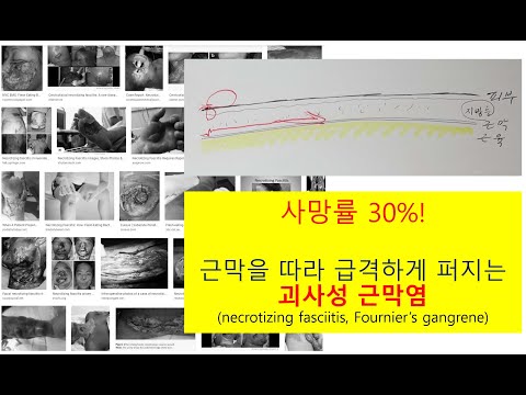 [#외과의사] 사망률 30%...#괴사성근막염...#포니에르괴저...근막을 따라 급격하게 퍼지는 위험한 병입니다....