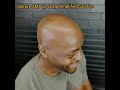 Scalp Micropigmentation (SMP) on dark skin