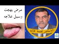 علاج مرض بهجت الدكتور الفايد علاج مرض بهجت الدكتور الفايد