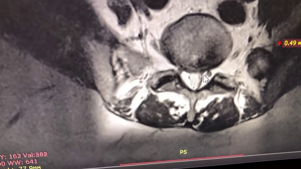 Лечение большой секвестрированой грыжи в 63 года