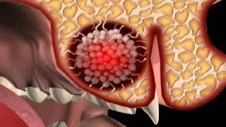 Dental Cyst - Cystostomy