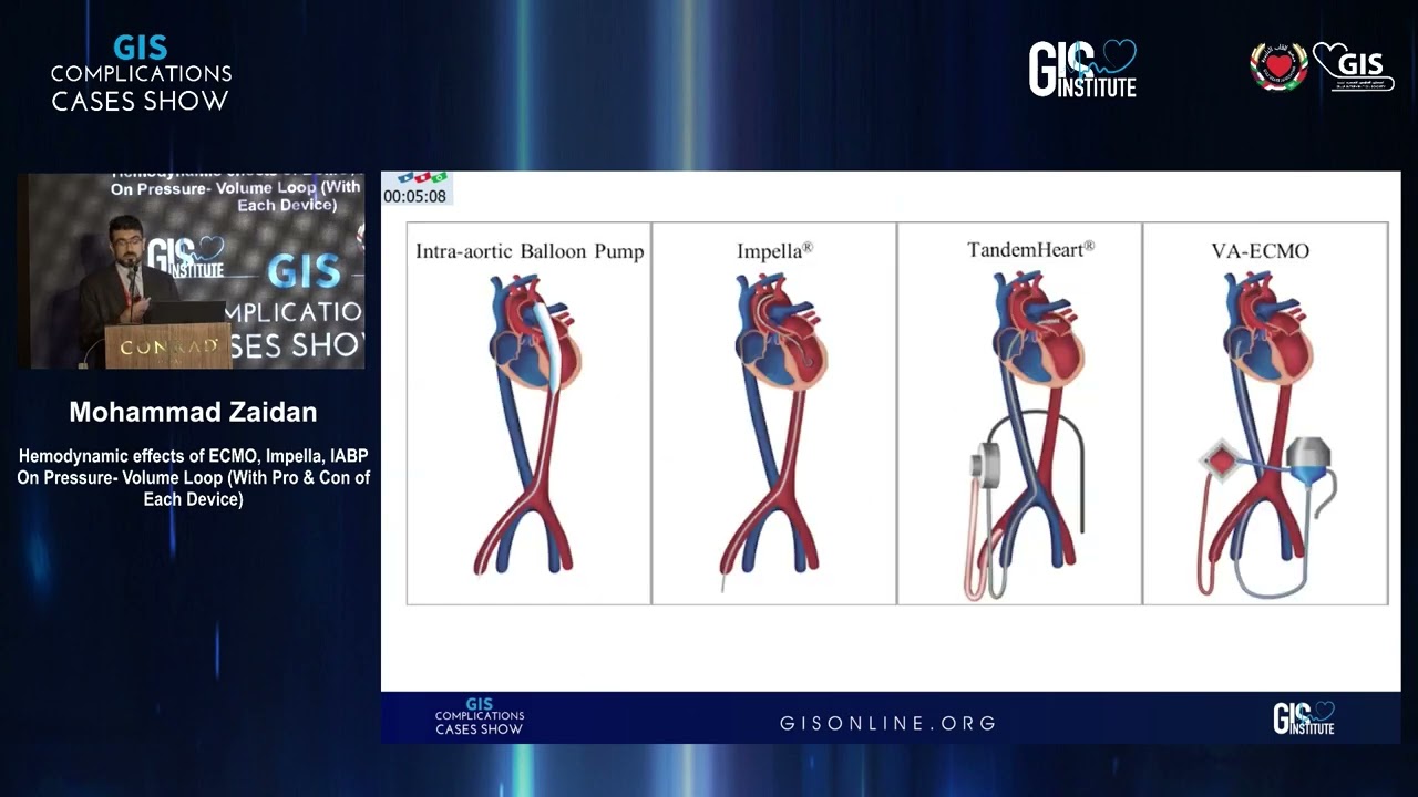 38  M  Zaidan   Hemodynamic effects of ECMO, Impella, IABP On Pressure  Volume Loop With Pro & Con o