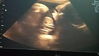 Bayi jordan di USG lucu banget guys