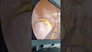 lap appendectomy