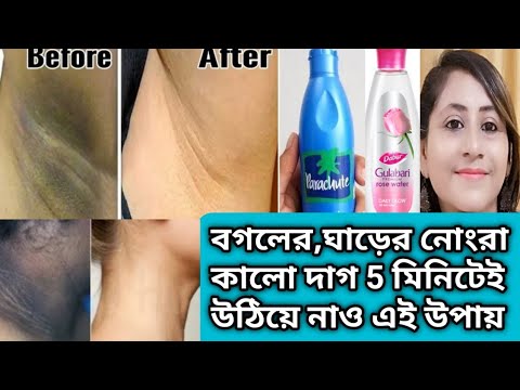 ভিডিও: কীভাবে বগলের ঝক্কি থেকে মুক্তি পাবেন