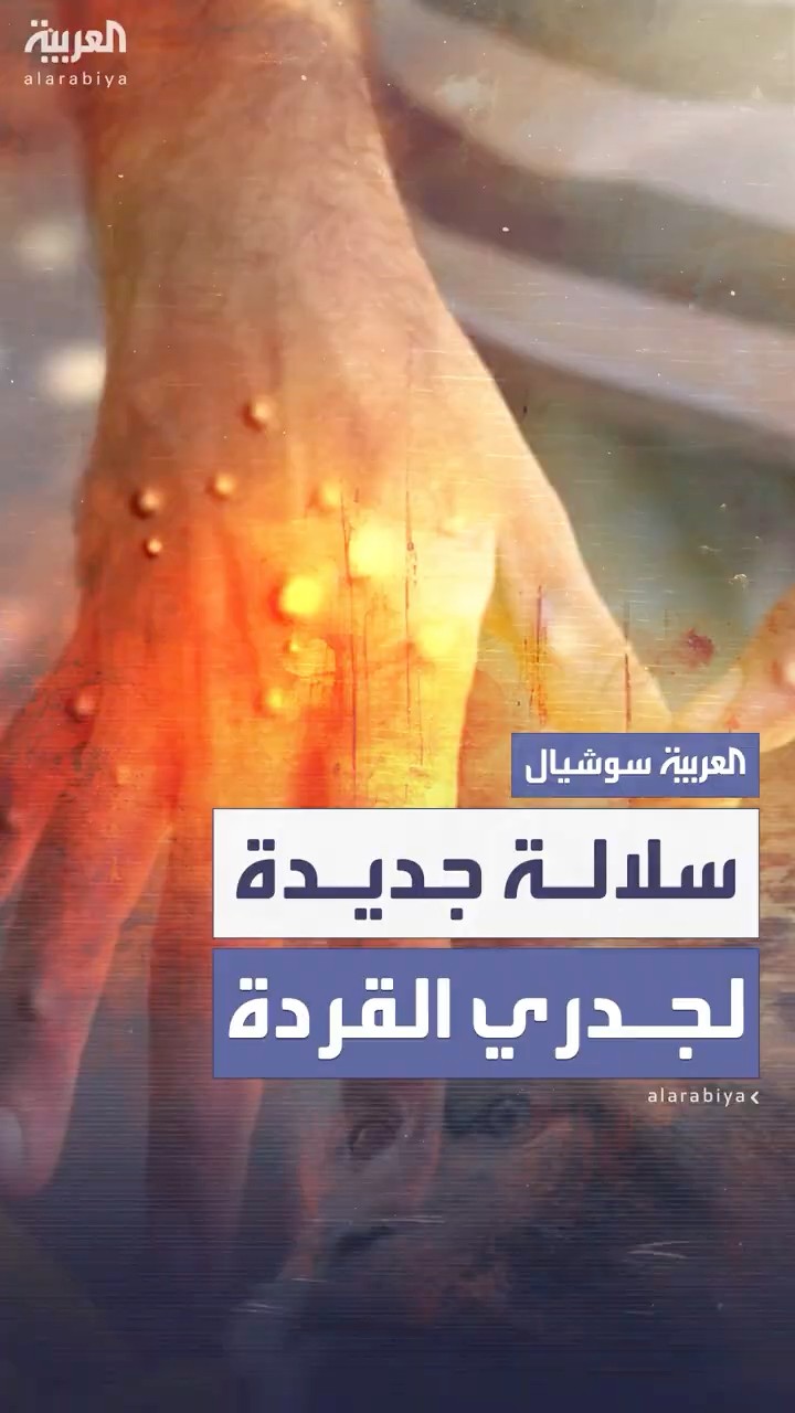 الصين ترصد سلالة متحورة جديدة من جدري القردة