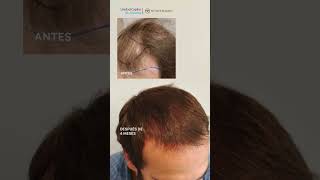 Resultado injerto capilar a los 4 meses (FUE Alta densidad)