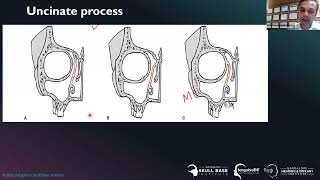 Webinar | Endoscopic Anatomy of Sinonasal and Anterior Skull Base | BEIRC