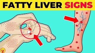 10 Warning Signs Of Fatty Liver Disease | Fatty Liver Symptoms | NAFLD Skin Signs | VisitJoy by VisitJoy 350 views 1 day ago 9 minutes, 54 seconds