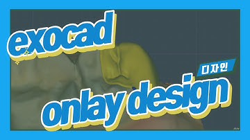 exocad onlay design