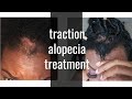 Took my Sew in out & I had a bald spot, again | Traction Alopecia & Treatment