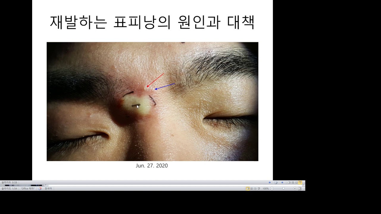 재발하는 표피낭의 원인과 대응 - YouTube 재발하는 표피낭의 원인과 대응 - Youtube