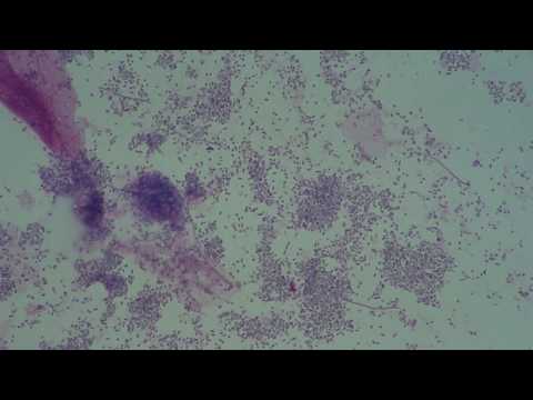 Video: Leptotrix - Leptotrix-Bakterien Im Abstrich Was Ist Das? Behandlungsmethoden