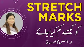 Stretch Marks on Belly After Delivery | Causes & Treatment in Urdu