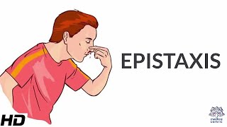 Epistaxis, Causes, SIgns and Symptoms, Diagnosis and Treatment.