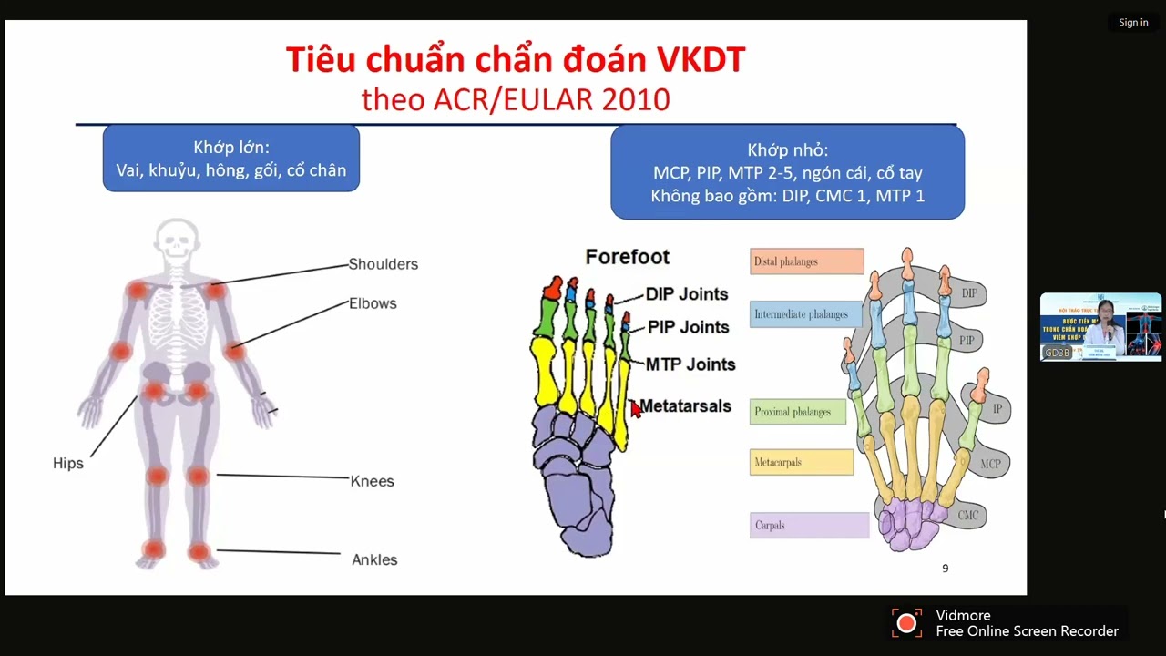 Cập nhật chẩn đoán và điều trị viêm khớp dạng thấp theo khuyến cáo | ThS. BS. Trần Hồng Thụy