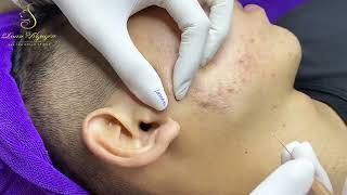 Loan Nguyen Acne Treatment 6zz