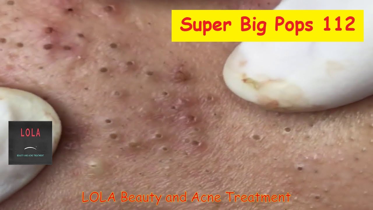 No Spaces in Between; Acne Removal 112; (Full Screen) Super Big Pops; Blackheads, Whiteheads