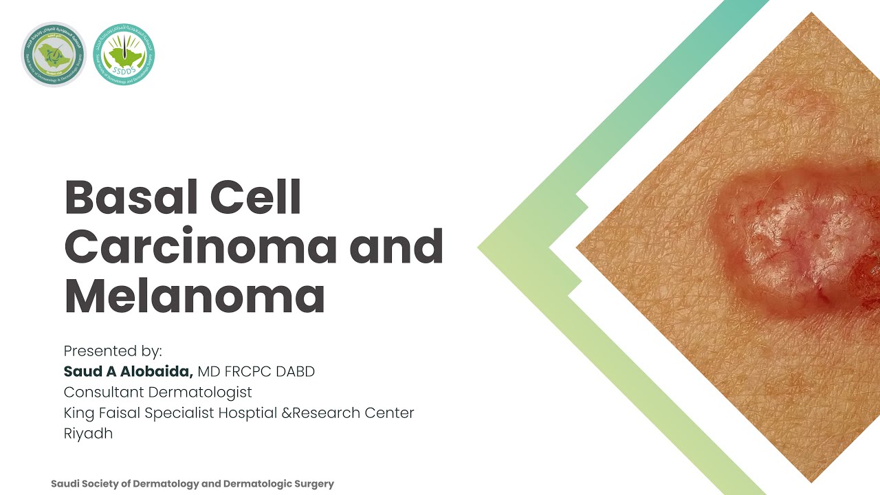 Lecture 15 | Basal Cell Carcinoma and Melanoma | Dr. Saud Alobaida