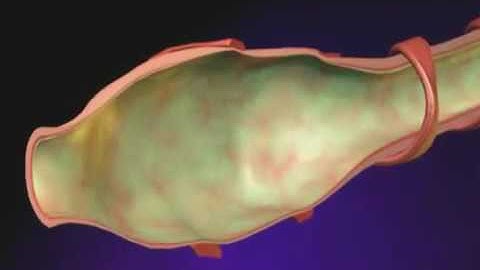 Bronchiectasis Animation   What is Bronchiectasis Video mp4   YouTube