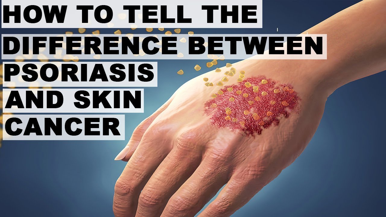 How To Tell The Difference Between Psoriasis And Skin Cancer Youtube