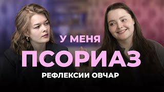 Я Больна Пожизненно | Что Такое Псориаз: История Любы