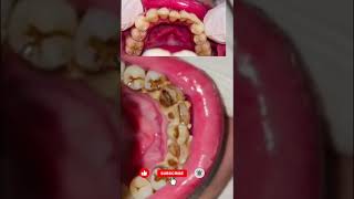 Beautiful Results of Dental Scaling  #dentist #dental