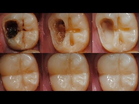 Wie du den Zahnverfall durch einfache Mittel stoppen kannst!