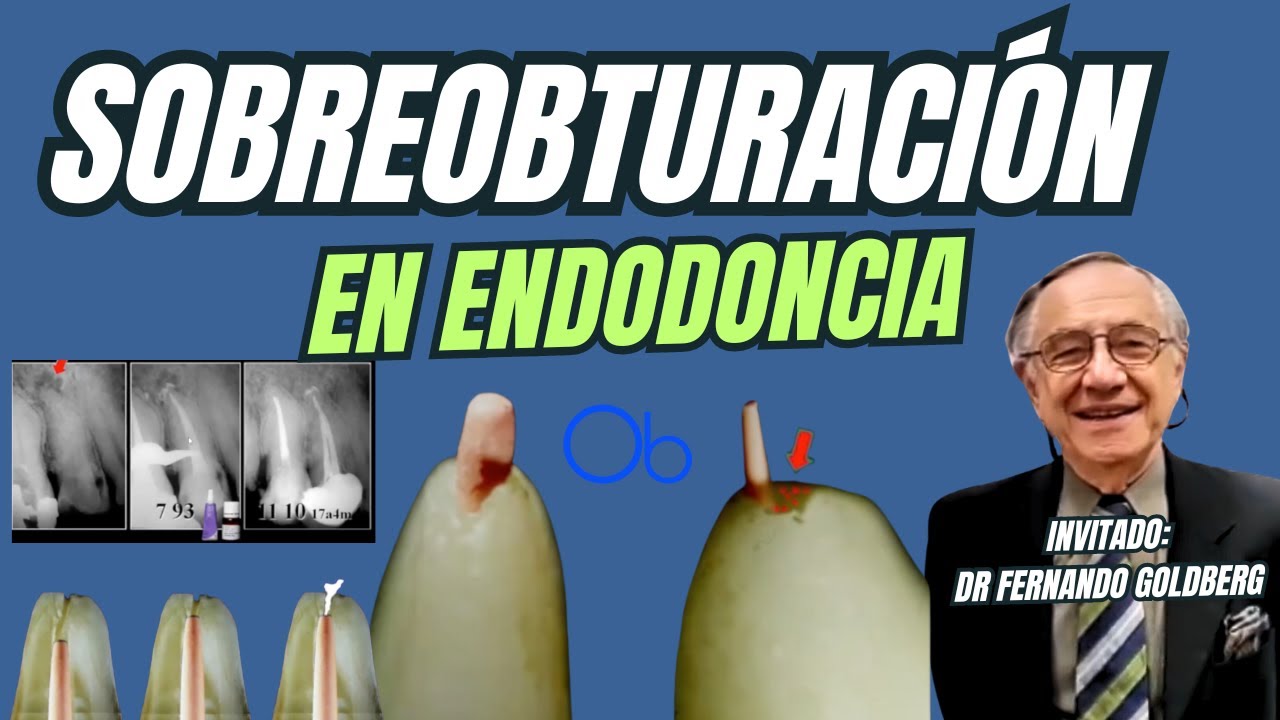Sobreobturación en Endodoncia 🦷 con el Dr Fernando Goldberg