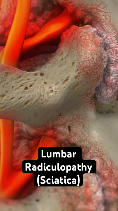 Sciatica Explained (3D Animation)
