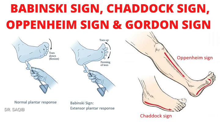 Babinski sign | Chaddock sign | Oppenheim sign | Gordon sign